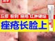 脸上长粉刺怎么治疗（脸上长粉刺用什么药最好）