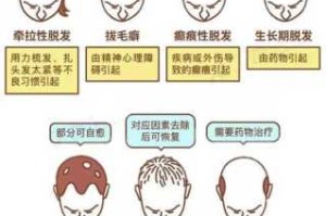 怎么预防遗传性脱发（怎么预防遗传性脱发）