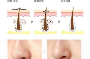 什么去毛孔（怎么去除毛孔）
