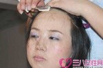 发际线太低怎么办,发际线过低如何调整