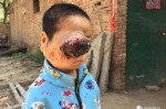 玉米男孩是什么病（玉米男孩是什么病?）