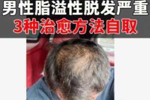 油脂性脱发怎么治（油脂性脱发怎么治）