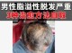 油脂性脱发怎么治（油脂性脱发怎么治）