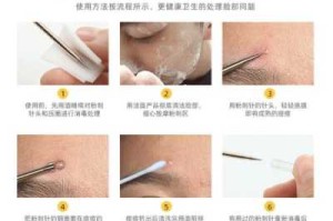 挤痘痘用什么消毒水,暗疮针怎么消毒才干净视频