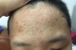 闭口痘痘是什么（闭口粉刺什么样子）