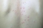 女人后背长痘什么原因（女人后背长痘什么原因引起的图片）