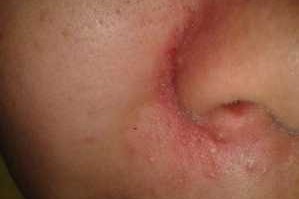 鼻子上一直长痘痘怎么办（鼻子周围的痘痘怎么去除）
