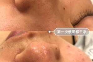 黑头怎么快速去除（如何去黑头最快最有效的方法）
