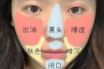 脸上有很多黑头怎么办（如何清理脸上的黑头）