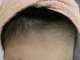 额头上有毛发怎么办（额头上有毛发怎么办小妙招）