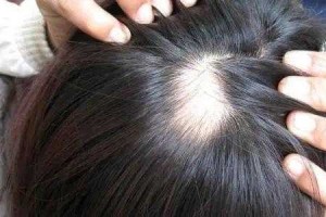 头发班秃是什么原因因起（头发出现班秃的原因）
