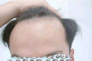 发际线高是怎么样,发际线高是什么样子