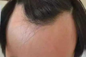 脑门秃怎么办（脑门秃发际线高怎么办）