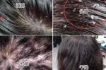 女人爱掉头发是什么原因（头发不油不痒没有头屑，但还是掉发严重）