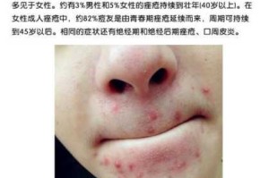 下巴长痘痘是为什么，有哪些原因,下巴为什么长痘痘红肿硬硬的还疼