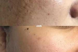 痘坑如何修复,怎么恢复痘坑最有效