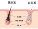 耳朵上面俩边长满了白发怎么办?是什么原因,吃什么治疗白头发最快