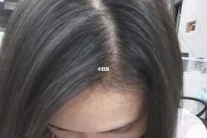 头上白头发多怎么办（头上白头发多怎么办可以拔掉吗）