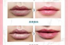唇纹明显怎么办（怎么淡化唇纹）