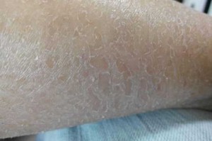 全身干燥起皮怎么办（全身干燥起皮怎么办才能有效啊）