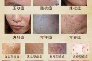 青春痘怎么去,痤疮怎么去除最有效