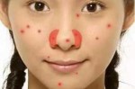 为什么鼻子上长痘痘怎么办（鼻子上面长痘痘原因）