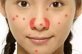 为什么鼻子上长痘痘怎么办（鼻子上面长痘痘原因）