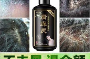 一到冬天头皮屑就一大堆，用什么洗发水比较好呢,冬天头皮屑多是什么原因怎么治疗方法
