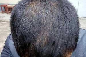 17岁男生为什么洗头老是掉头发,男人为什么容易脱发的原因