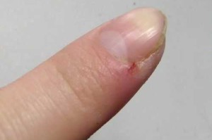 手指裂开口子如何处理，手指裂口子的原因,手指皮肤干裂怎么办图片