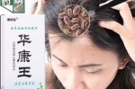 去屑止痒小妙招,怎么样去头皮屑止痒最有效