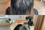 先天性头发少怎么办（头发天生少，毛囊少）