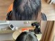 先天性头发少怎么办（头发天生少，毛囊少）