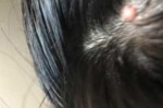 头皮上长疙瘩是什么原因（上火头皮上长疙瘩是什么原因）