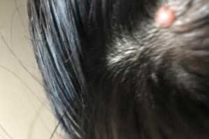头皮上长疙瘩是什么原因（上火头皮上长疙瘩是什么原因）
