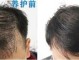 为什么男人老了头顶会秃,男人为什么会秃顶的原因