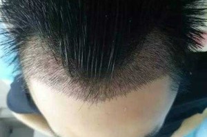 什么是发际线高,什么叫发际线高大全