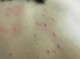 后背长很多痘痘是什么原因（男人后背长很多痘痘是什么原因）