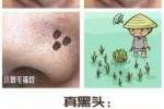 鼻子上有黑头怎么去除,13岁鼻子上好多黑头怎么办