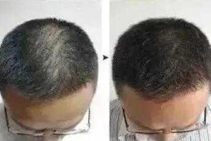 头顶稀疏能恢复浓密吗,头顶稀疏怎么变浓密