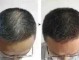 头顶稀疏能恢复浓密吗,头顶稀疏怎么变浓密