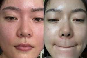 鼻头毛孔大怎么收缩（鼻子毛孔变大了怎么收缩）