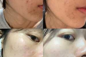 痘印怎么去除小窍门（减轻痘印的方法）