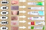 怎么除去痘痘（怎么除去痘痘印）
