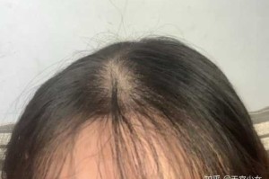 两边头发少是什么原因（两边头发少是什么原因引起的）