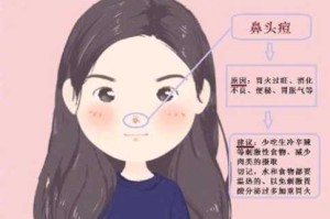 鼻梁长痘痘怎么回事（鼻子鼻梁长痘痘怎么回事）