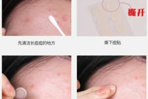 痘痘怎么快速消除,逗逗怎么最快消除在家简单方法