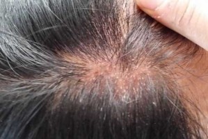 染发后严重过敏，该怎么办,白发多染发过敏怎么办