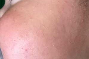 脸上长脂肪粒怎么办,小孩脸有脂肪粒怎么办