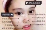 鼻尖长痘怎么消除（鼻尖长痘怎么快速消去）